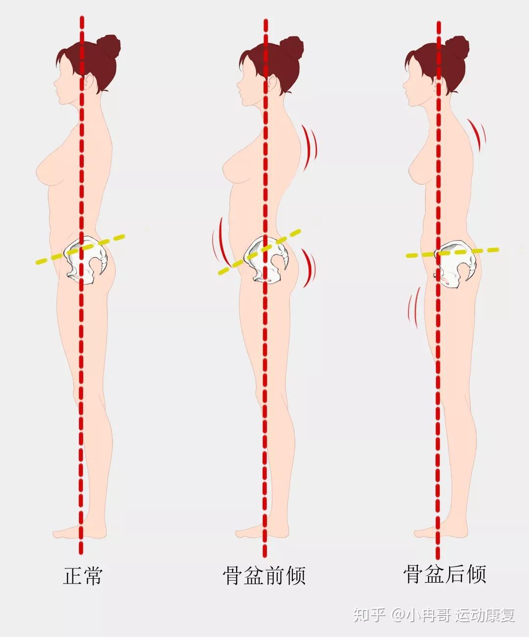 谁的骨盆最端正——我拥有最端正的骨盆形态
