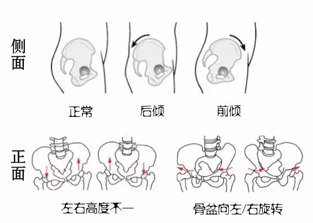 探究人体之美，骨盆端正性视频解析