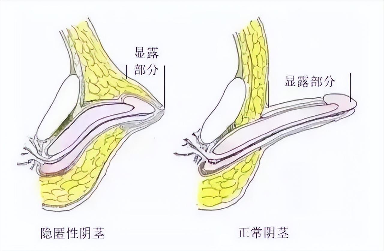 无声疾病威胁儿童健康，警惕孩子无声的健康杀手