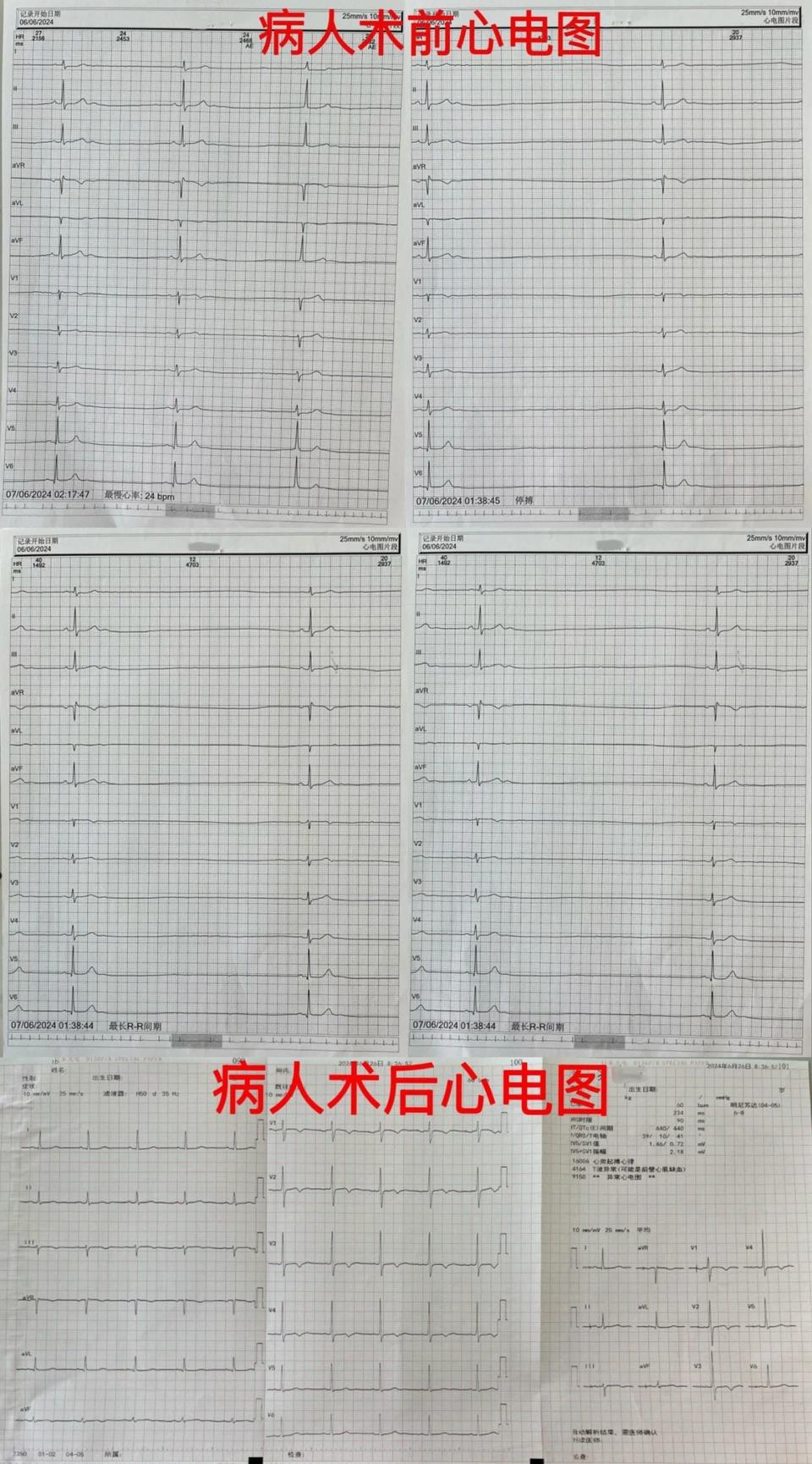 东营市中医院成功实施永久性抗磁共振心脏双腔起搏技术，开启心脏治疗新时代